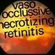 Vasoocclusive Necrotizing Retinitis